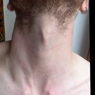 Adam's Apple