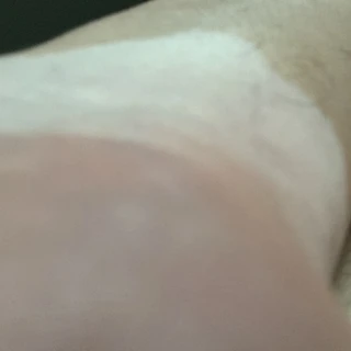 Vitiligo Body Exposed